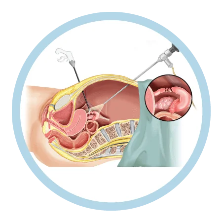 O uso da laparoscopia para a realização das cirurgias de retirada dos focos  visíveis da endometriose tem se mostrado superior à técnica abdominal, By Dr. Yulo Césare